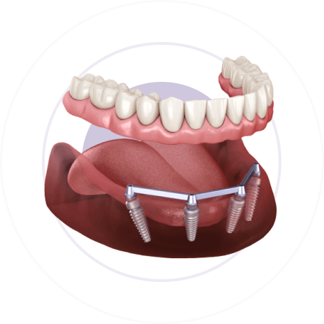 В чём заключается технология All-on-4